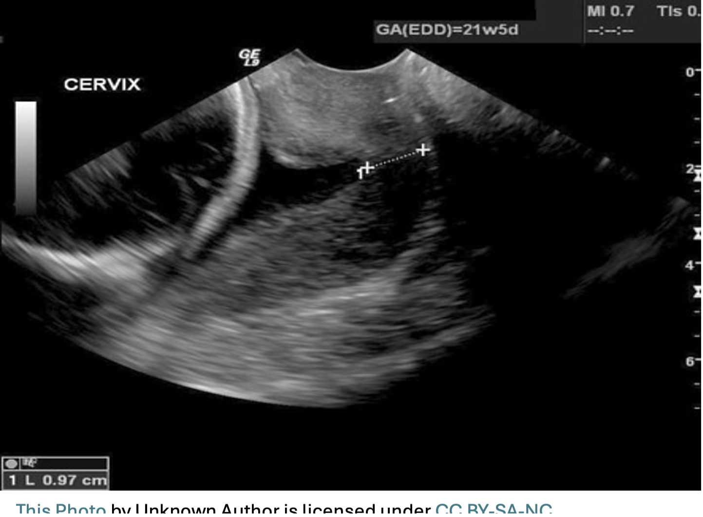 Cervical Length Assessment (incl baby growth)